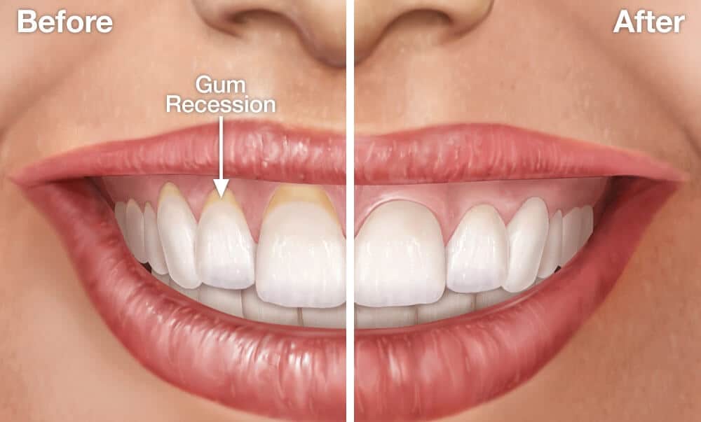 Repairing Gum Recession
