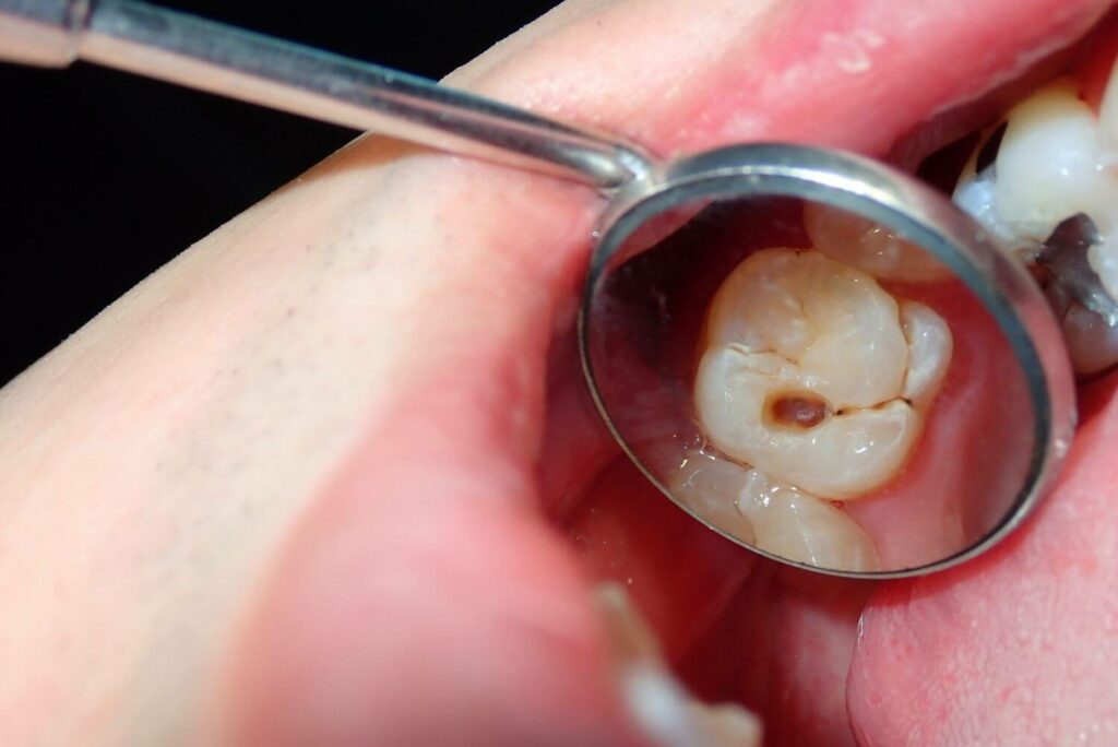 The Role of Bacteria in Tooth Decay