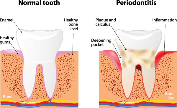 Human Periodontal Disease Stages