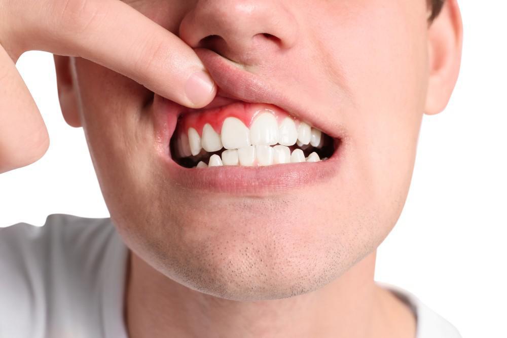 receding gums treatments
