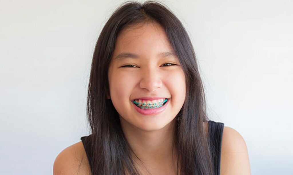 Fixing Crooked Teeth with Orthodontic Treatments