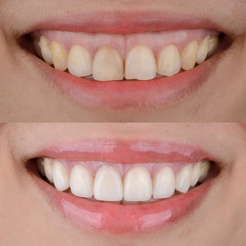 Improving Gum Appearance with Gum Contouring
