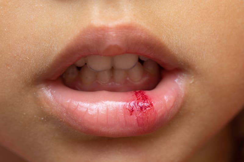 Lip or Tongue Injury: First Aid for Soft Tissue Damage