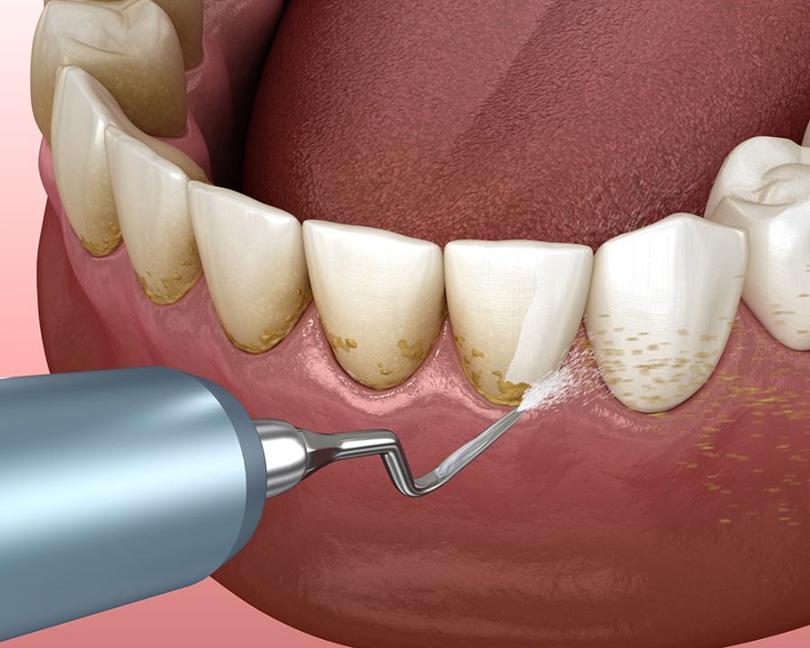 Professional Dental Treatments for Gum Disease and Tooth Sensitivity