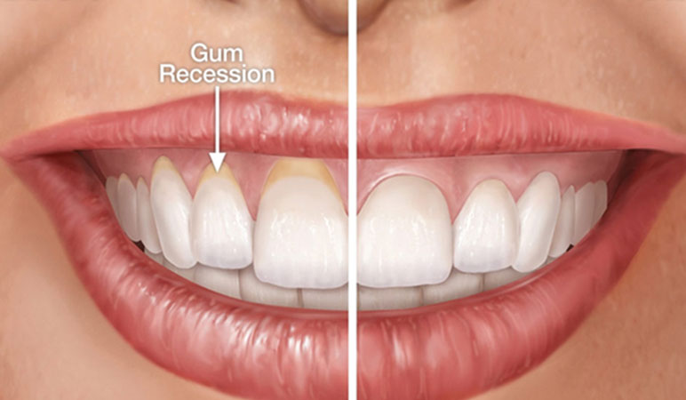 Receding Gum Repair