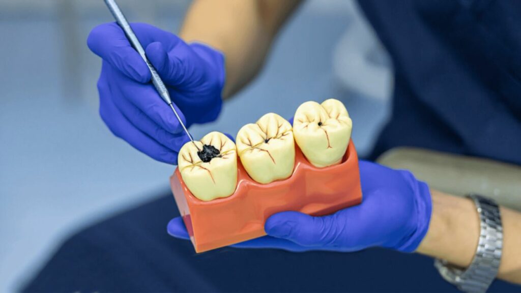 Treating Tooth Decay and Cavities