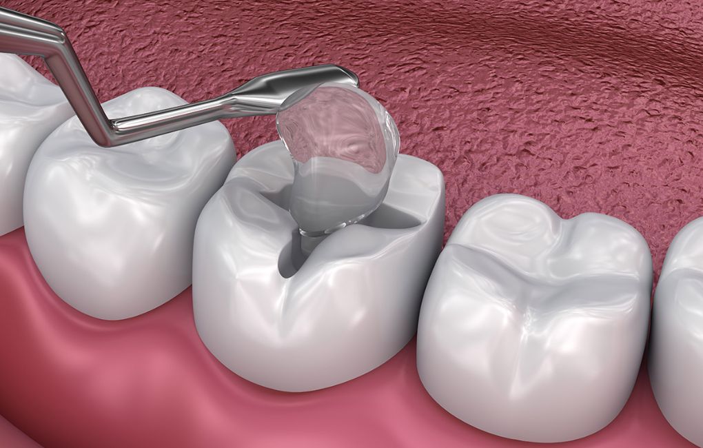 Treating a Broken Dental Restoration: Temporary Fixes